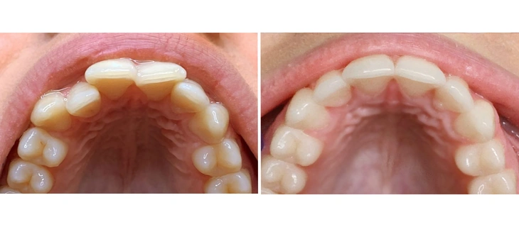 Teeth Braces