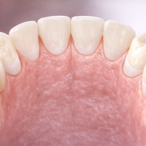 Dental Veneers