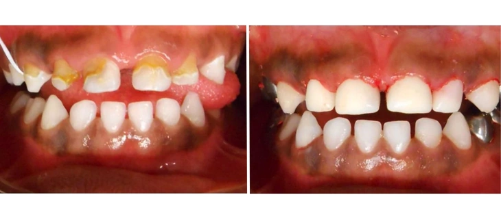 Pediatric Dentistry
