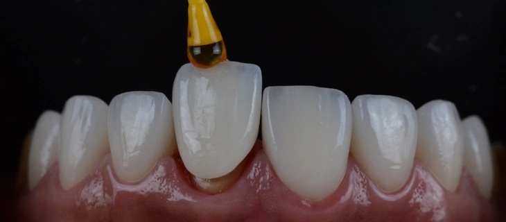 Placement of Dental Veneers