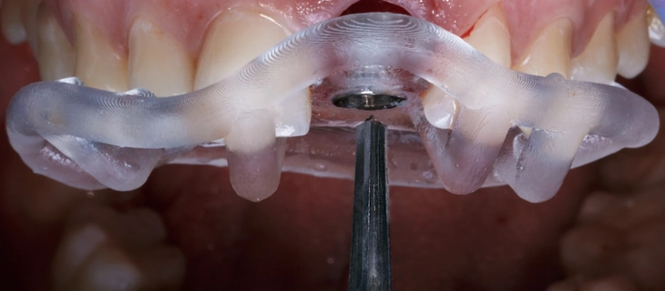 Full Mouth Dental Implants