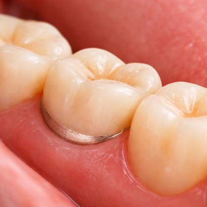 porcelain-fused-to-metal-crowns