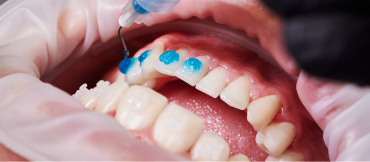 Preparing the Tooth Surface