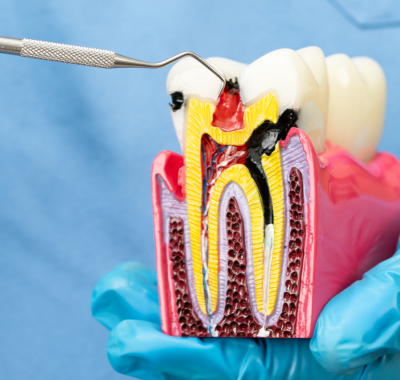ROOT CANAL TREATMENT