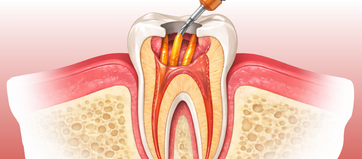 Root Canal