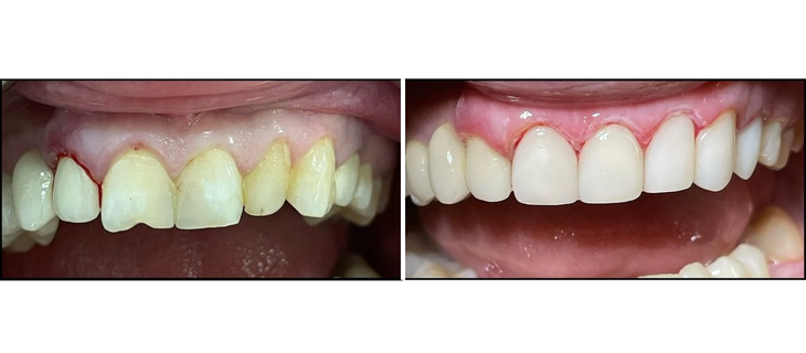 Scaling and Root Planing Before and After