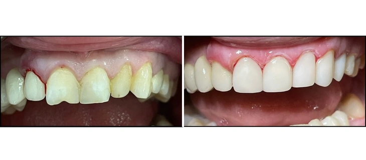 Scaling and Root Planing Before and After