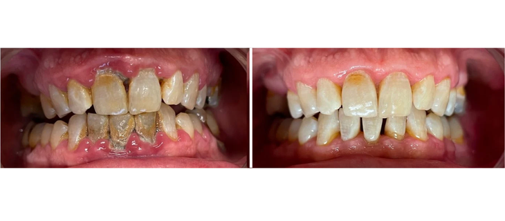 Scaling and Root Planing Before and After