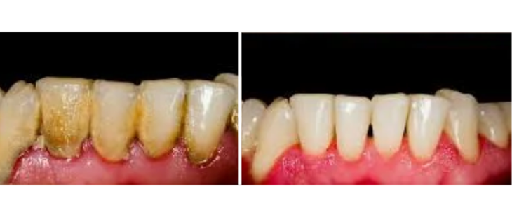 Scaling and Root Planing Before and After