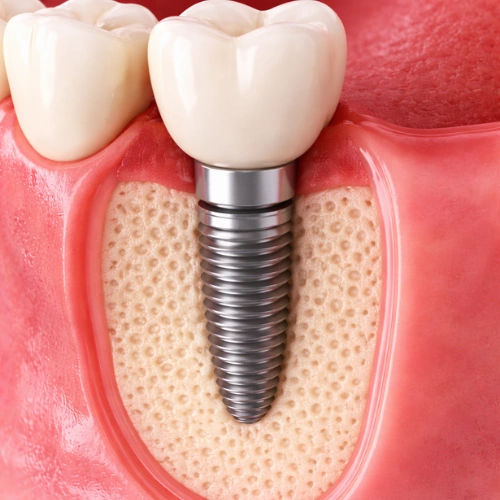  Single Tooth Implant