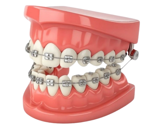 Teeth Braces Treatment