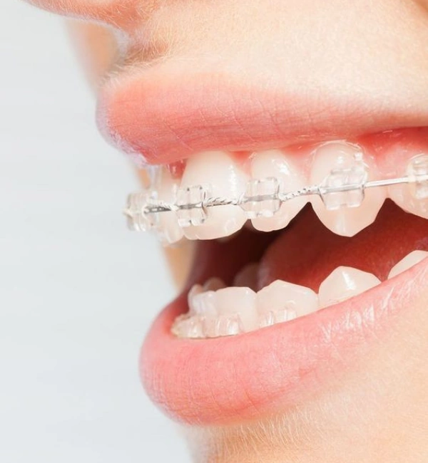 Teeth Braces Treatment