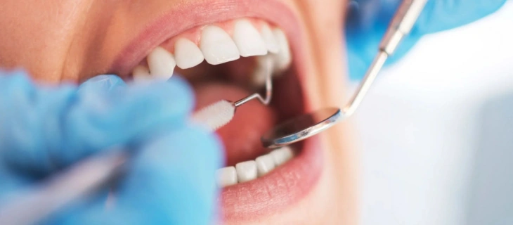 Teeth Whitening