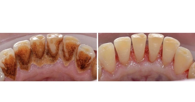Teeth Cleaning