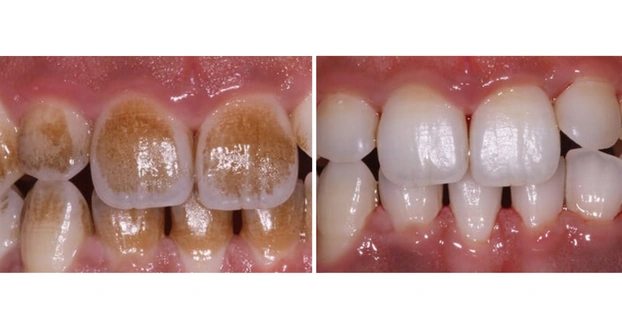 Teeth Cleaning