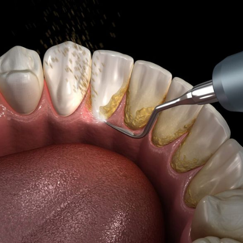 Gross Debridement Cleaning
