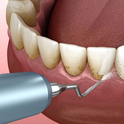 Periodontal Maintenance Cleaning