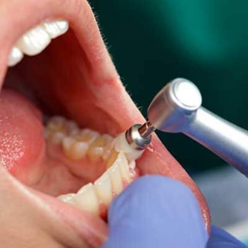 Prophylaxis Cleaning