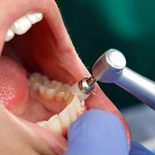 Prophylaxis Cleaning