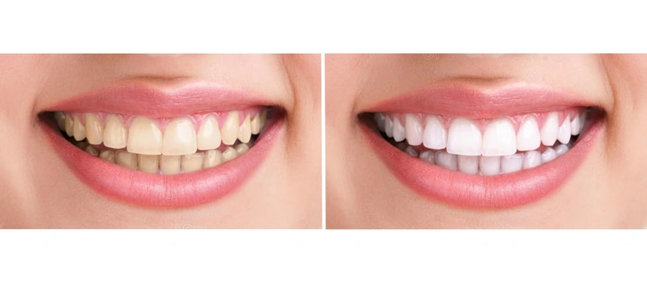 Teeth Whitening