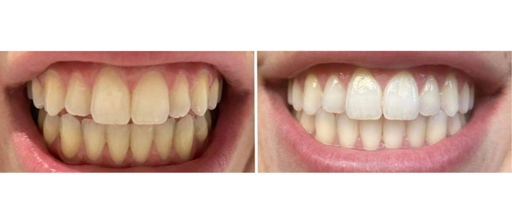 Teeth Whitening