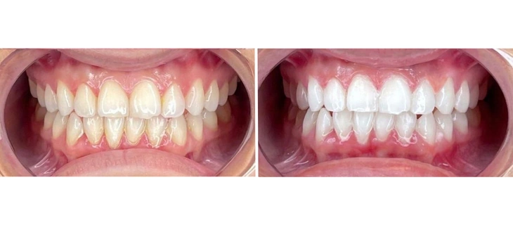 Teeth Whitening