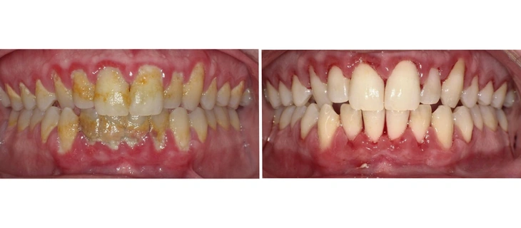 Teeth Whitening