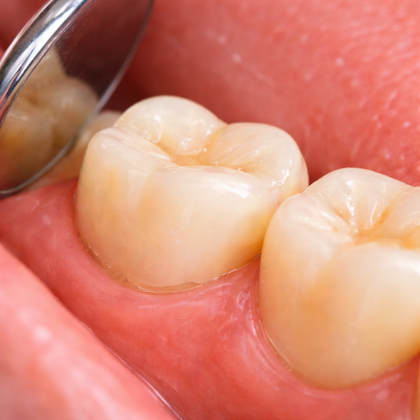 temporary-resin-crowns