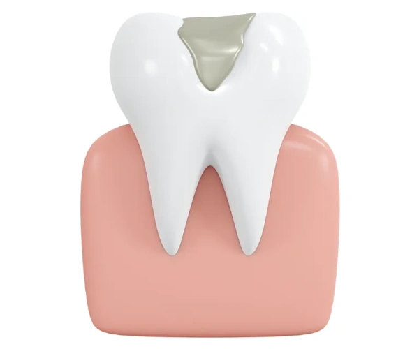 Dental Fillings