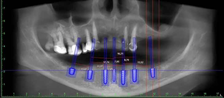 Full Mouth Dental Implants