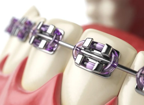 Teeth Braces Braces