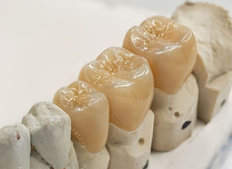 Dental Bridges