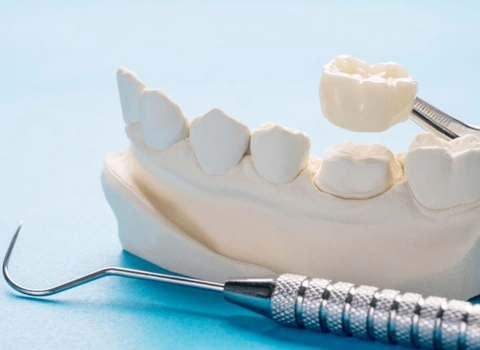 Dental Crowns