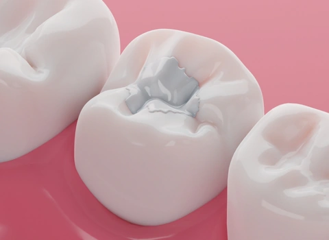 Dental Fillings