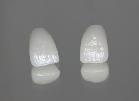 Dental Veneers
