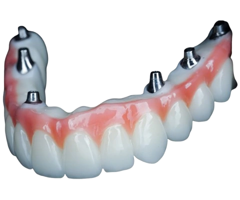 Dental Implants