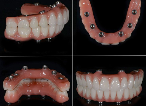 Full Mouth Dental Implant
