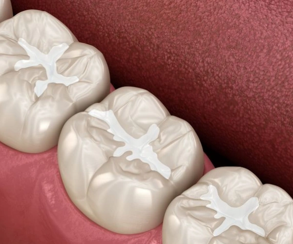 Dental Bonding