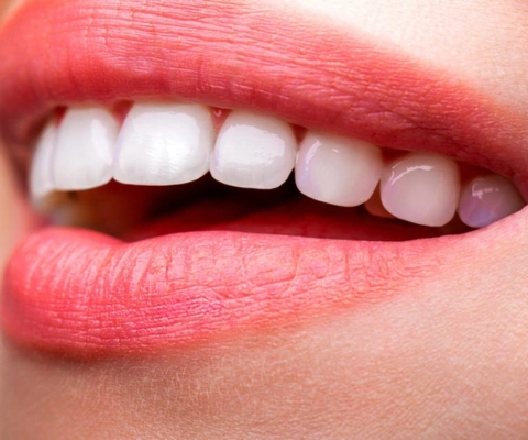 Teeth Whitening
