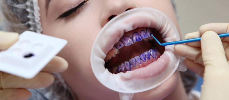 Preparing Your Mouth