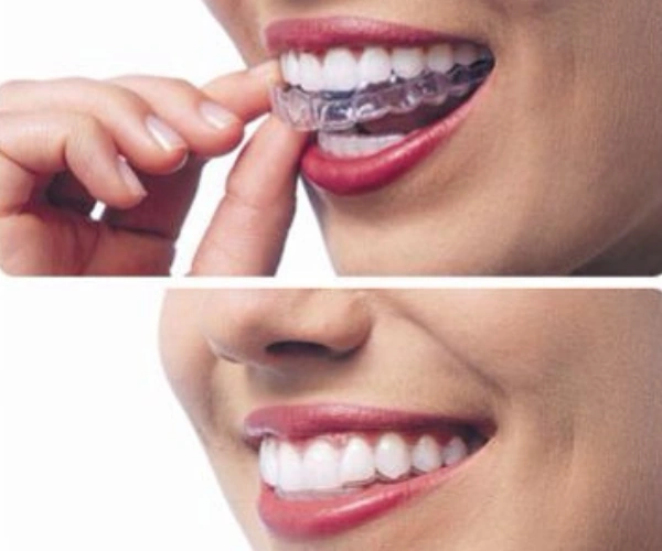 Why Choose Invisalign Clear Aligners?