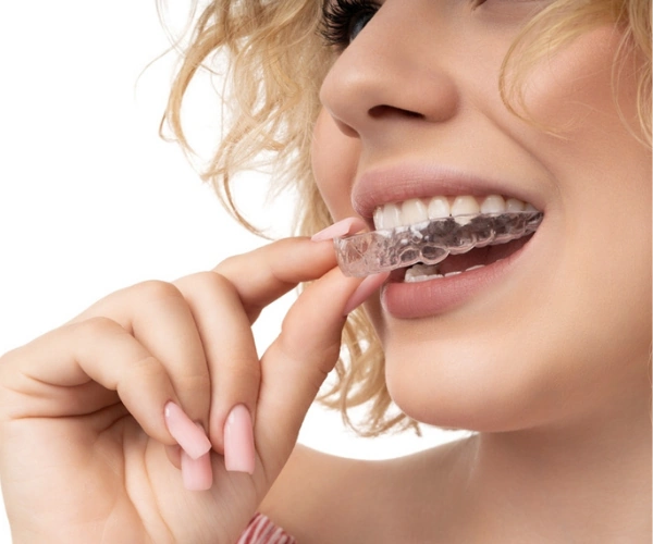 Clear Aligners