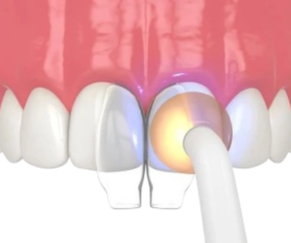Dental Bonding