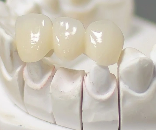 Dental Bridges