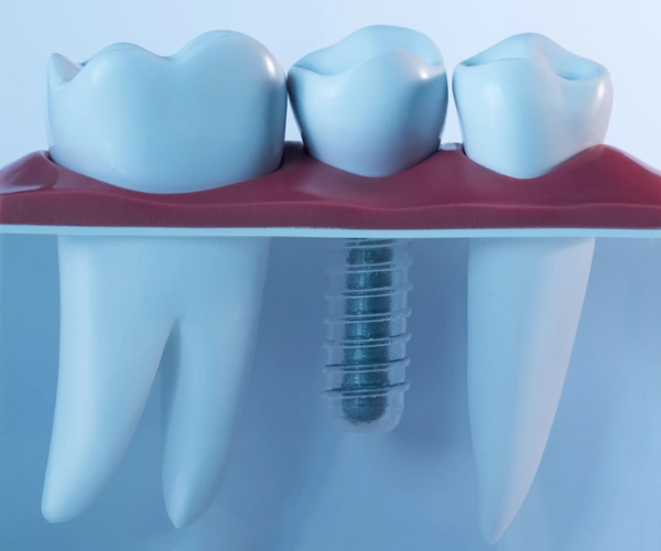 Dental Implants