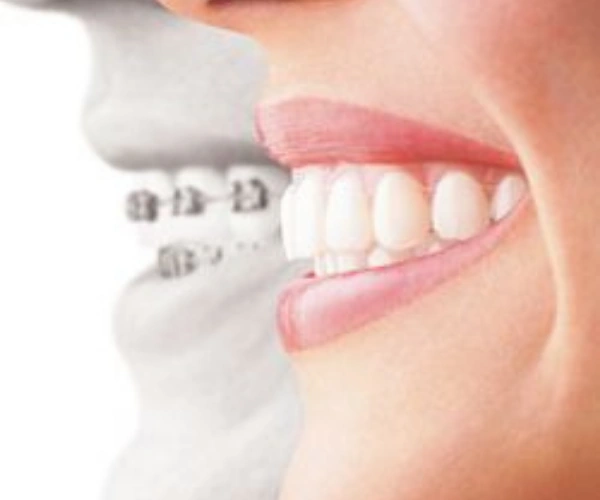 Teeth Braces Treatment