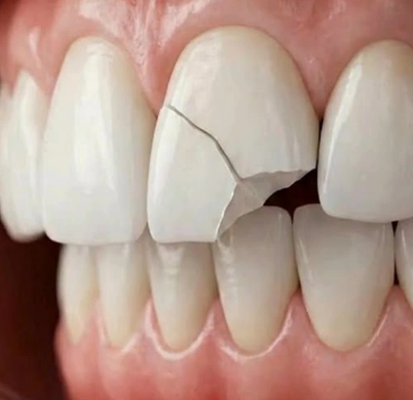 Dental Bonding Benefits