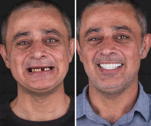 Why Do You Need Full Mouth Dental Implants?