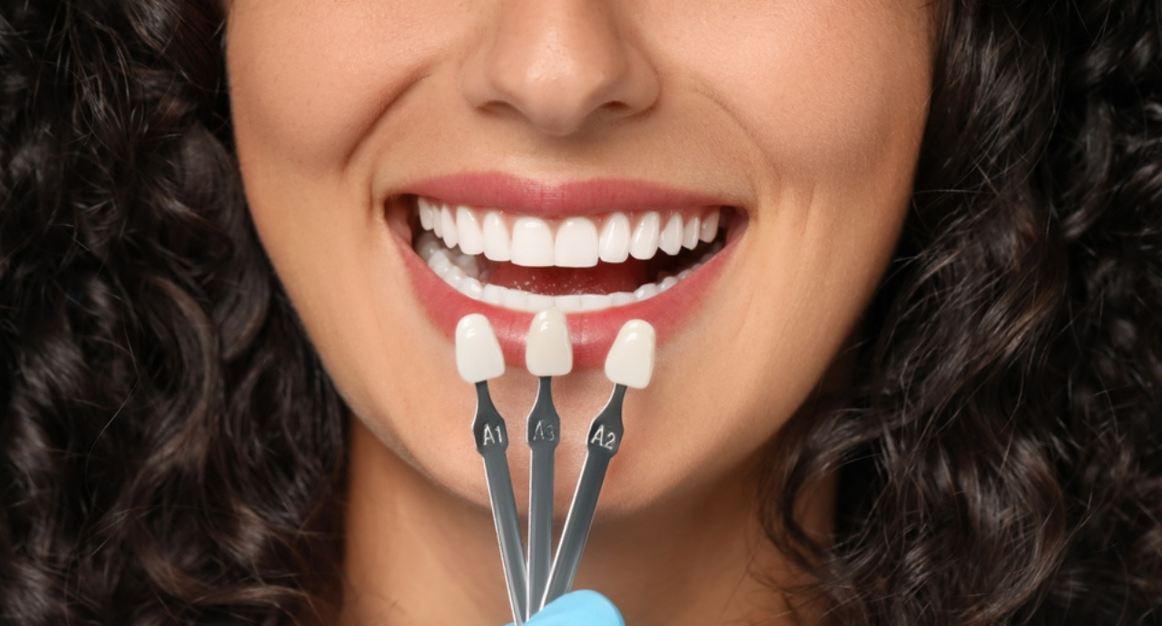 No-prep veneers treatment for a natural radiant smile at Smile Invent Dental Clinic