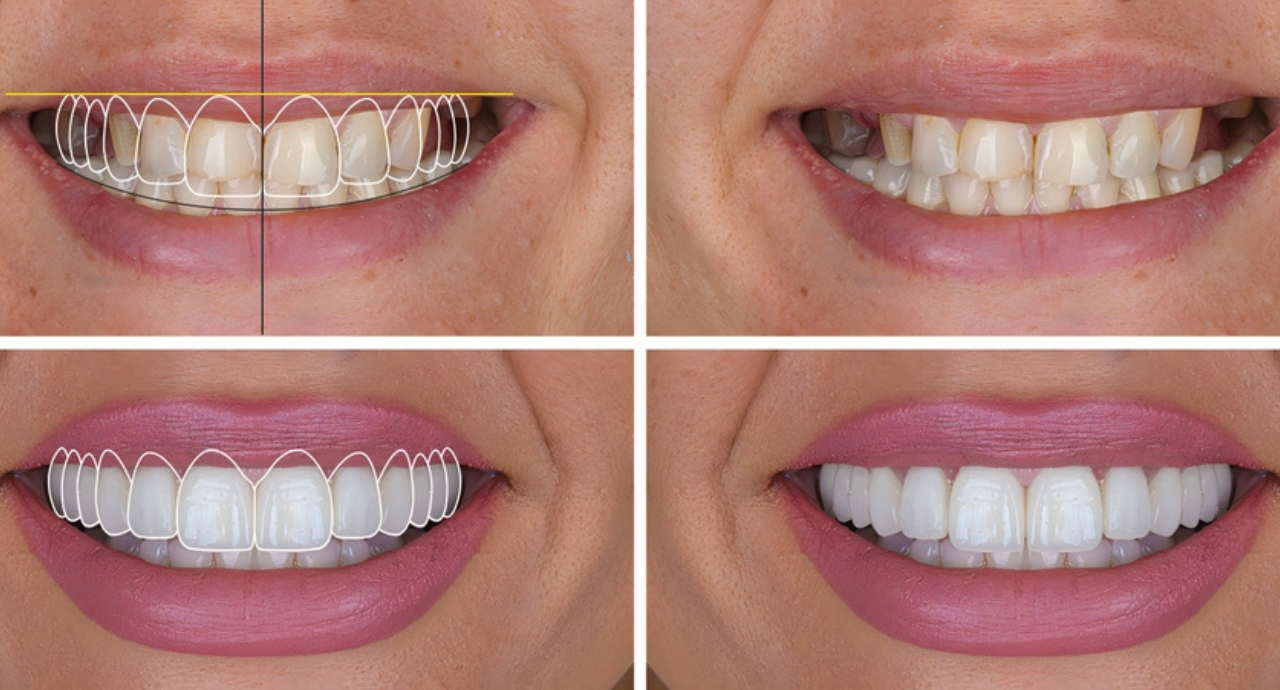 Digital Smile Design The Future Of Customized Smiles